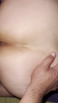 Un tumor i 4